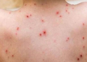 अझै नियन्त्रणमा आएन ढोरपाटनमा दादुरा संक्रमण