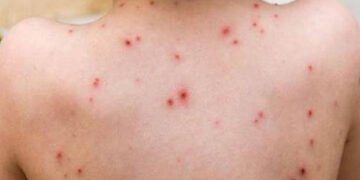 अझै नियन्त्रणमा आएन ढोरपाटनमा दादुरा संक्रमण