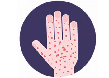 दुई महिनापछि ढोरपाटनमा दादुरा सङ्क्रमण रोकथाम