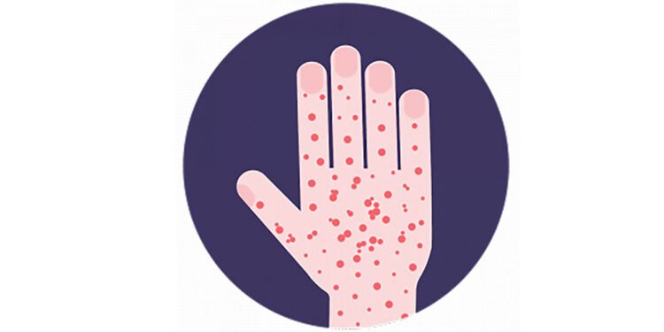 दुई महिनापछि ढोरपाटनमा दादुरा सङ्क्रमण रोकथाम